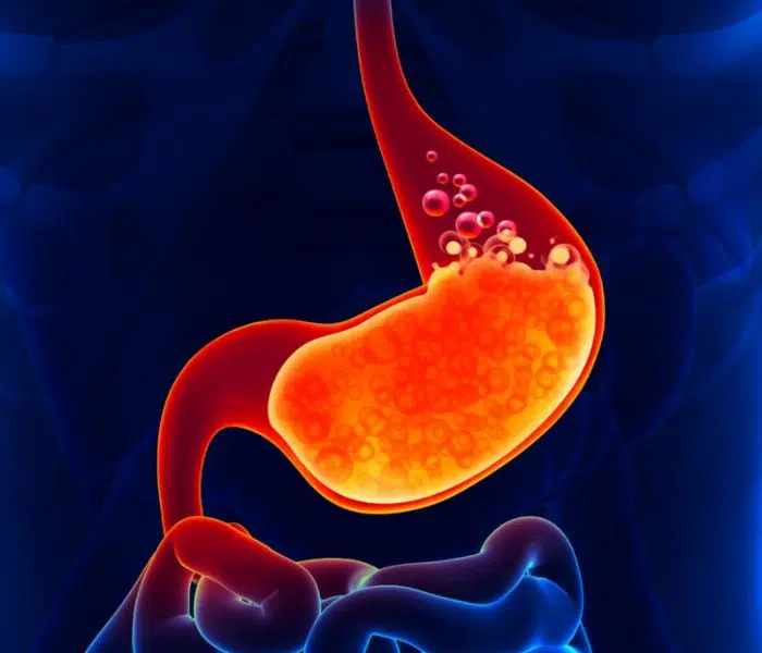 Ways to eliminate gastric
